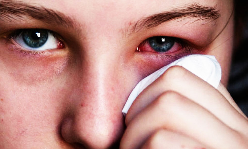 कन्जकटीवाईटिस