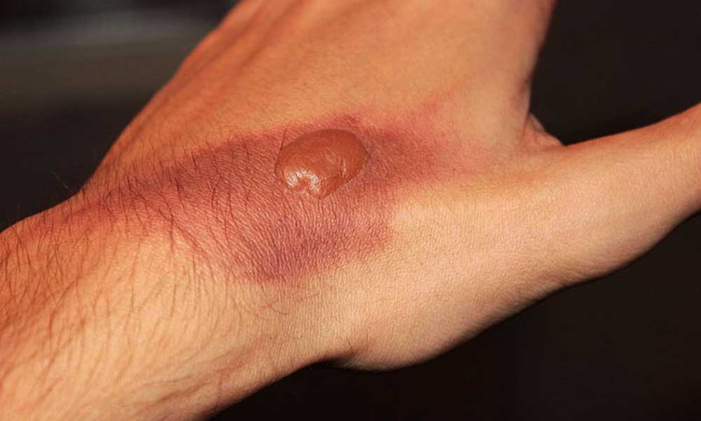 जली हुई त्वचा की देखभाल