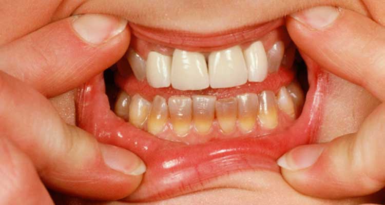 Image result for दांतों पर से धब्बे