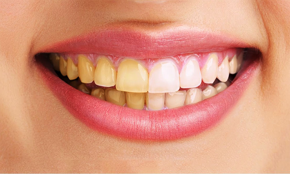 Image result for दांतों पर से धब्बे