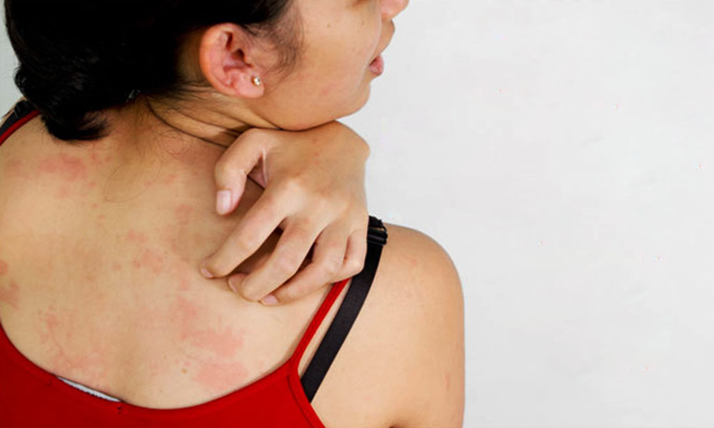 घमोरियों के घरेलु उपाय