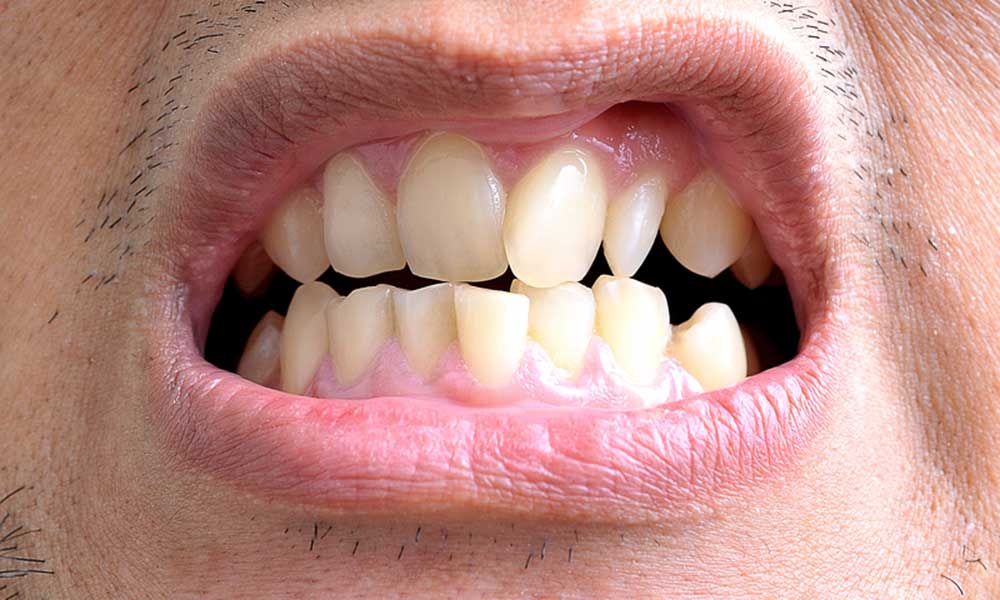 टेढ़े-मेढ़े दांतों को सीधा करने के घरेलु उपाय