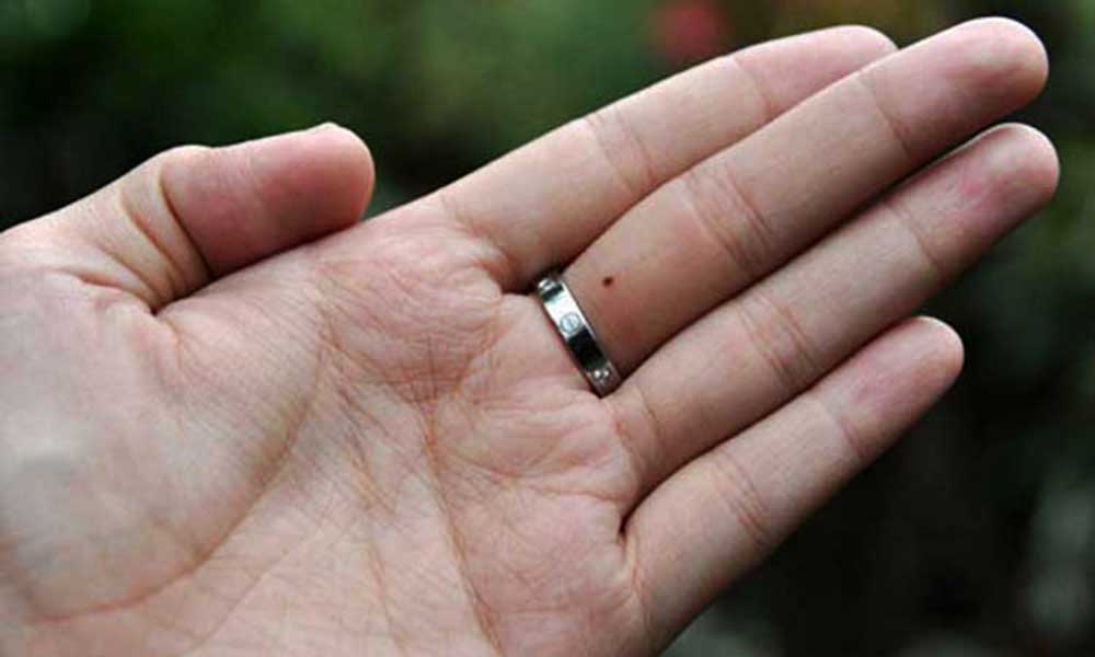 हाथों की उंगलियों के तिल