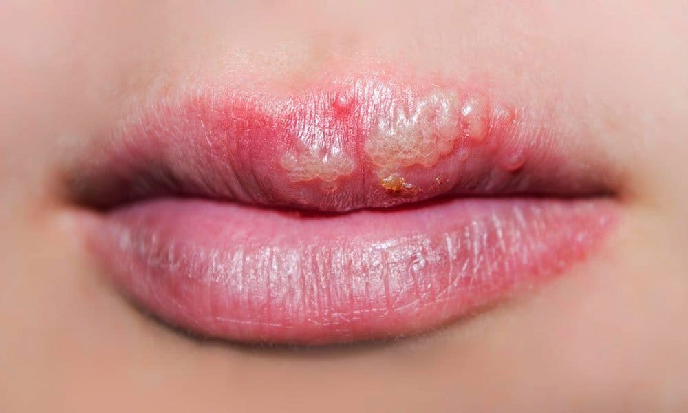 मुंह के छालों के घरेलु उपाय