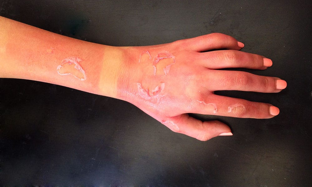 हाथ जलने पर घरेलु उपाय