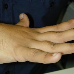 हाथ की उँगलियों के बीच का गैप