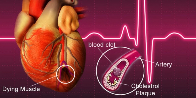 heart-diseases