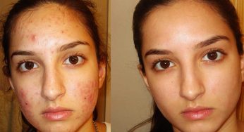 Natural Home Remedies To Get Rid Of Your Acne Scars And Dark Spots