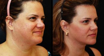 5 Easy Ways To Get Rid Of Extra Face Fat