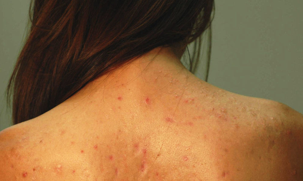 Remedies To Prevent Back Acne