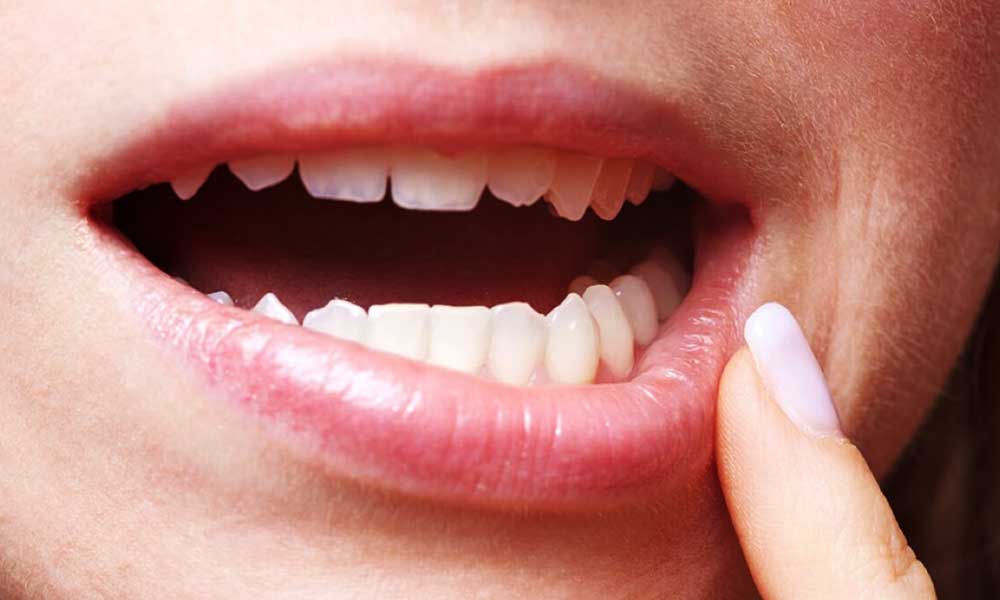 Remedies To Prevent Canker Sores