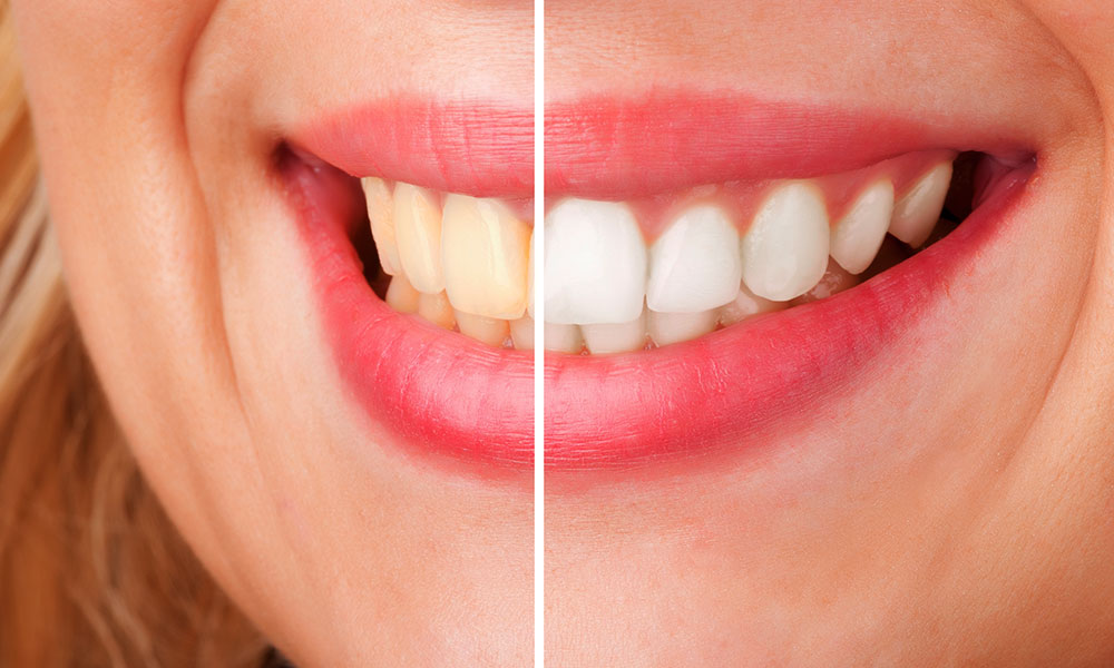 Home Remedies For Teeth Whitening