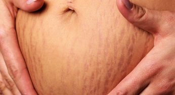 6 Super Natural Ways To Get Rid Of Stretch Marks On Body!