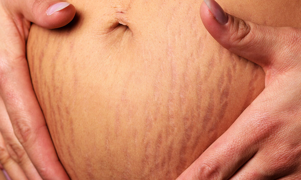 Ways To Prevent Stretch Marks