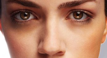 5 Things You Do That Causes Dark Circles Under Your Eyes!
