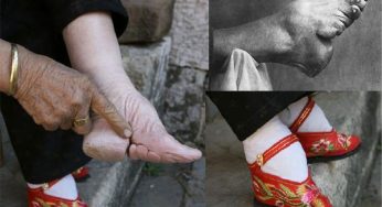 These Painful Procedures For Beautification Of Women In History Will Surely Boil Your Blood