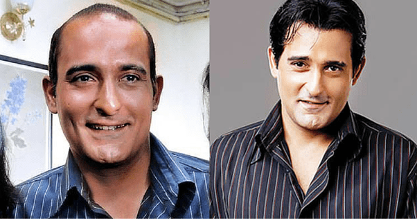 Here Is A List Of Bollywood Celebs Who Did Hair Transplant Surgery!