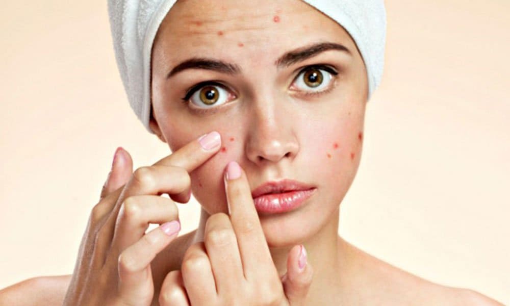 Dietary modifications for acne