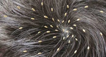 Home Remedies For Lice That Will Ser Your Hair From Tiny Parasites