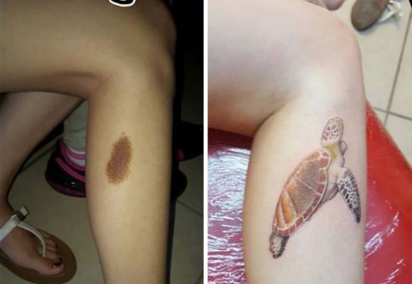 Birthmarks Into Tattoos