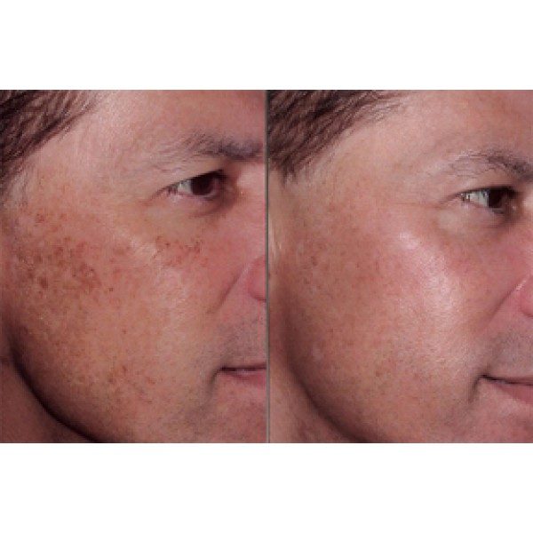 Benefits Of Aloe Vera Gel